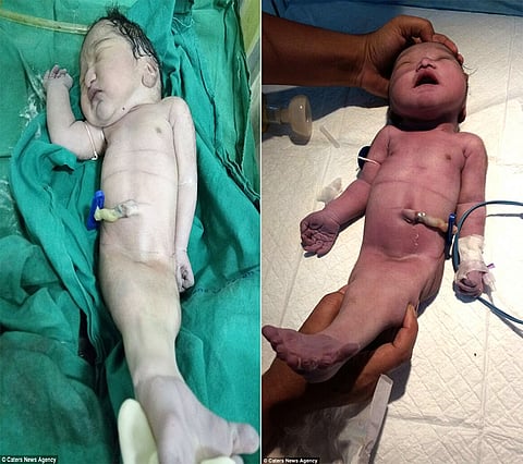 "الديلي ميل": هندية تنجب "حورية بحر"