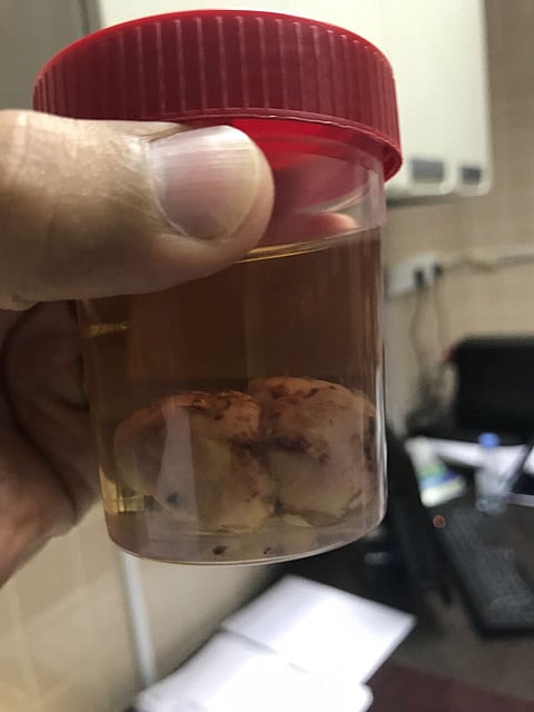 استئصال ورم نادر من فم مولودة في مستشفى الولادة والأطفال بأبها