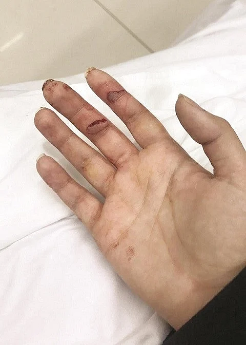 كويتية تنجو من الذبح في الأردن.. والدها: حجابها أعاق وصول السكين لرقبتها