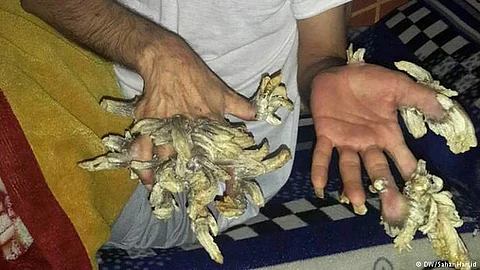 عراقي يتحول إلى "شجرة" .. وهذا هو السر