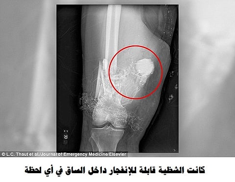 أطباء يستدعون الإطفاء وقوة متفجرات لغرفة العمليات.. قصة الساق المتفجرة