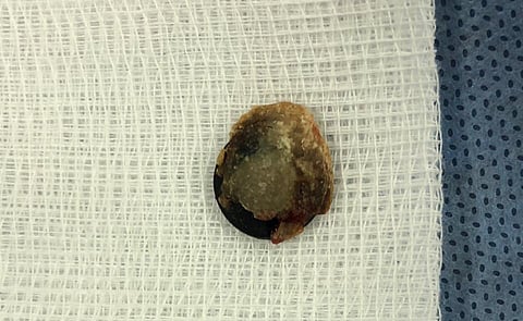 استخراج "بطارية ساعة" من أنف طفل بمستشفى القريات بعد معاناة استمرت عامًا