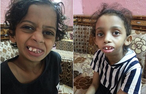 عملية جراحية تنهي معاناة الطفلين ملتصقَي الفك منذ الولادة "رغد وفهد" بجازان