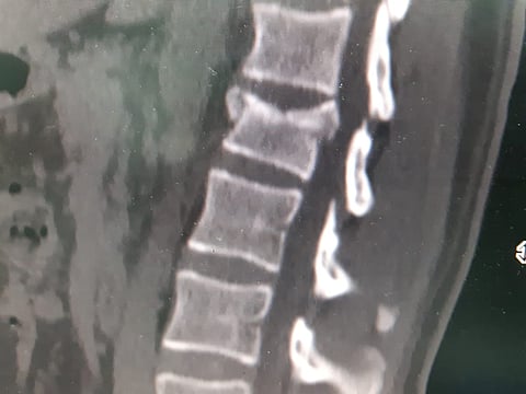 طريف .. جراحة تُنقذ مصاباً في حادث مروري من شلل الأطراف السفلية