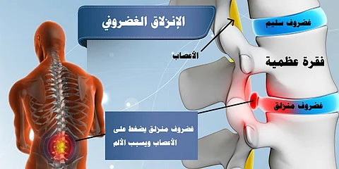 هل تعرف الانزلاق الغضروفي؟.. 6 خرافات شائعة عن آلام الظهر والرقبة