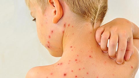 ارتفاع حالات الوفاة بالحصبة في أوروبا إلى 72 حالة