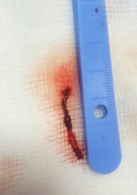 نجاح قسطرة دماغية تداخلية لمريض بمستشفى عسير المركزي