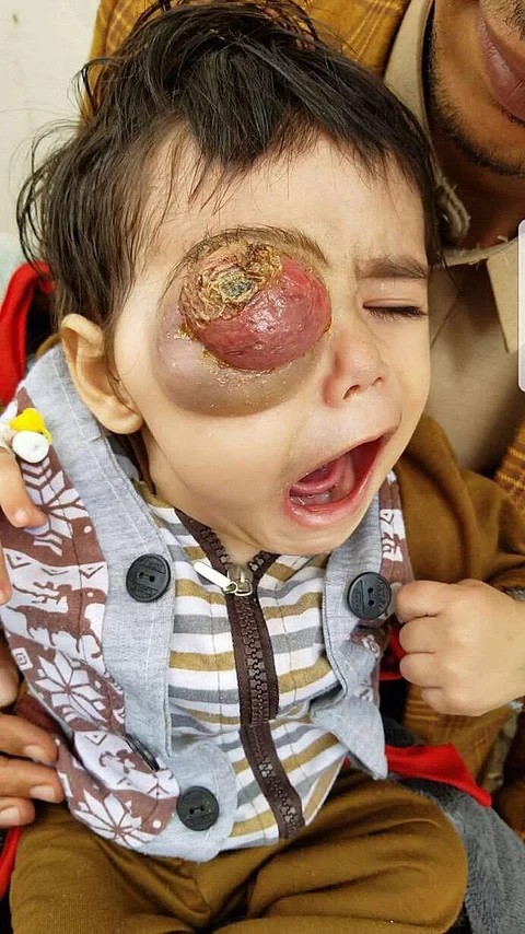 "الخبيث" يسرق عين طفل يمني ووالده يناشد لإنقاذه