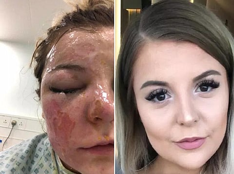 كيف تسببت "نصيحة عبر الإنترنت" بفَقْد فتاة إحدى عينيها؟