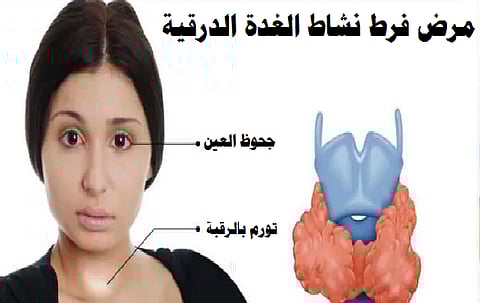 أغذية "تربك" عمل الغدة الدرقية .. عليك الحذر منها