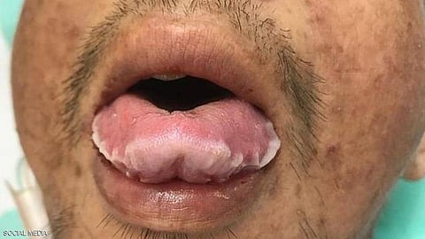 احذر.. إذا لاحظتَ طبقة بيضاء على اللسان فهذا مؤشر على مرض نادر