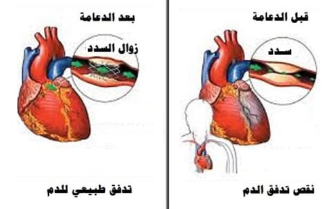 دراسة: الدعامات ليست أفضل من الأدوية لمرضى القلب