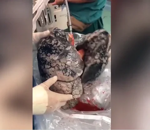 25 مليون مشاهدة لفيديو "الرئة السوداء".. "الإعلان الأفضل ضد التدخين"