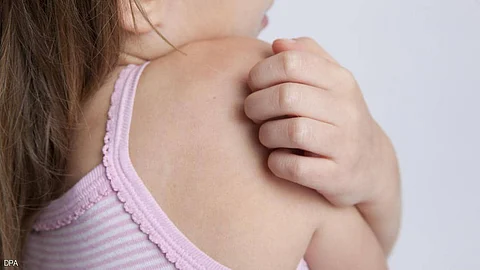 الرابطة الألمانية لأطباء المراهقين: انتبهوا فالصدفية تهاجم الأطفال أيضًا