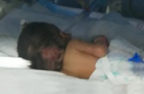 لغز موت الأطفال بمستشفى الباحة يعود من جديد.. وفاة توأم بعد 47 يومًا في الحضانة
