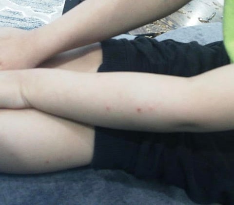 البعوض يشوّه أجساد أطفال "طويق الرياض".. والأمانة تردّ: نكافح