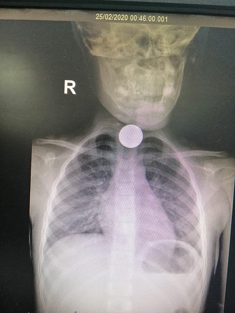 تدخل طبي ناجح مع حالة طفلة ابتلعت قطعة معدنية