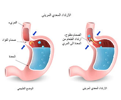 حُرقة المعدة في شهر رمضان.. ما هي أسبابها وكيف يمكن الوقاية منها؟