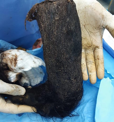 شاهد.. 2 كجم من الشعر داخل بطن عشرينية و"تخصصي الطائف" يُنهي معاناتها