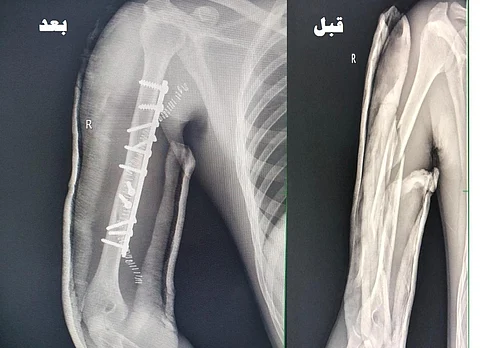 جراحة ناجحة بالأسياح لتثبيت كسر متفتت لشاب نتيجة حادث مروري