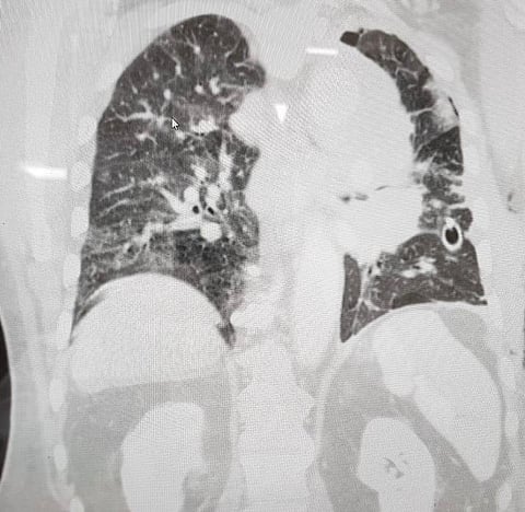 جازان .. منظار جراحي ينقذ مريضًا 75 عامًا من تجمُّع مُزمن على الرئة