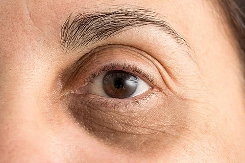 هذه العادات السيئة تتسبّب في ظهور الهالات السوداء.. يجب تجنبها