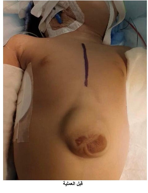 بالغة التعقيد والخطورة.. جراحة نادرة لـ"طفلة بقلب خارج القفص الصدري" بالرياض