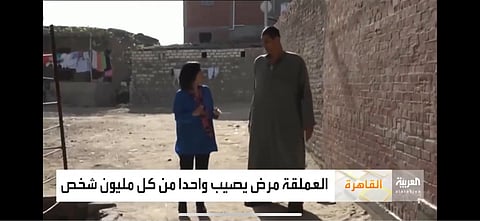 مصري وأخته يعانيان من "العملقة".. طولهما يتجاوز المترين وهذه أمنيتهما قبل الموت