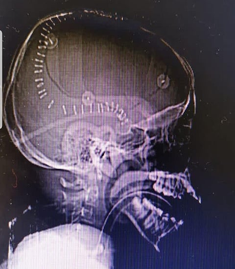 مكة المكرّمة.. حادث سير يدخل شاباً في وفاة دماغية وجراحة الساعتين تنقذه