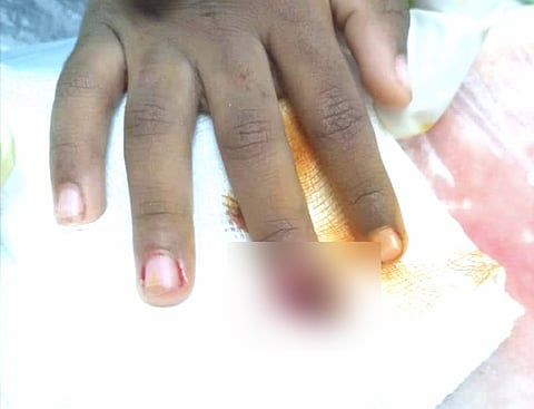 فتش عن الباب.. جراحة عاجلة تنقذ أصبع طفل من البتر بأبو عريش