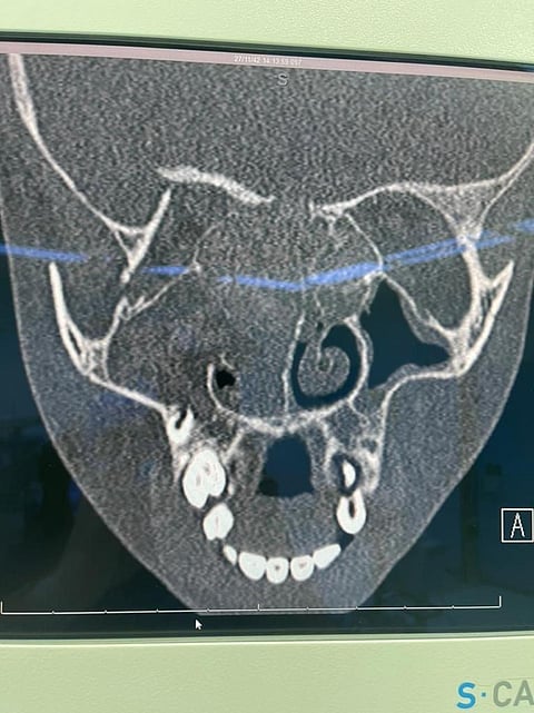 جدة.. عملية منظار تُنهي معاناة طفلة من الصداع بمستشفى الملك عبدالعزيز