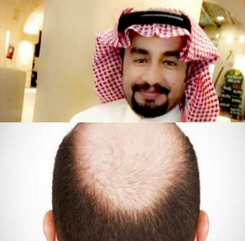 اكتشفت أنه "أصلع".. زوجة تطلب الطلاق عقب يومَيْن من زواجها.. وقانوني يُعلِّق