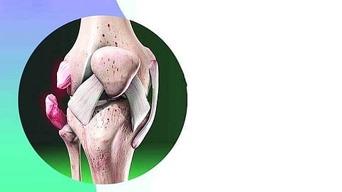 लिगामेंट टियर : कारण, लक्षण एवं होम्योपैथिक उपचार