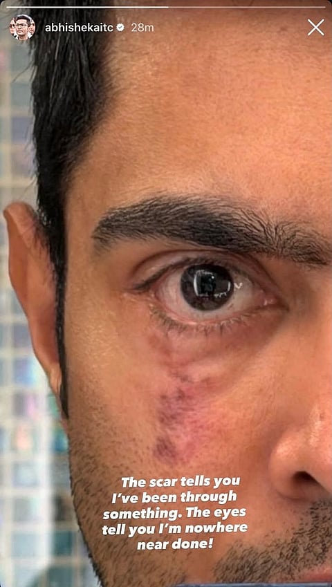 अमेरिका में इलाज के बीच अभिषेक बनर्जी ने आँख की तस्वीर सोशल मीडिया पर शेयर की