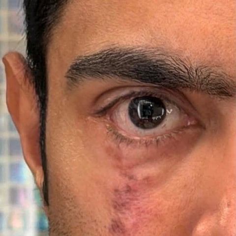 अमेरिका में इलाज के बीच अभिषेक बनर्जी ने आँख की तस्वीर सोशल मीडिया पर शेयर की