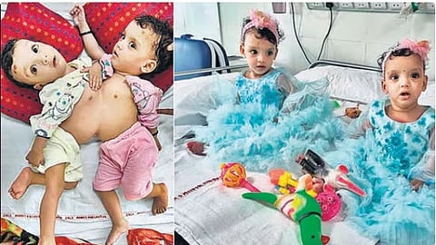 Delhi AIIMS ने रिद्धि सिद्धि को दी नई जिंदगी