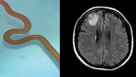 महिला के दिमाग में मिला जिंदा रेंगता हुआ कीड़ा, देखते ही दंग रह गए डॉक्टर