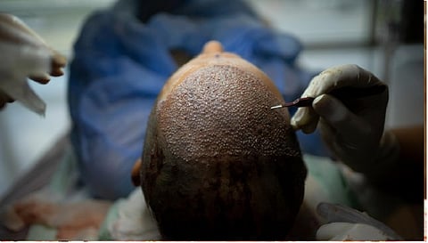 हेयर ट्रांसप्लांट (सोर्स- इंटरनेट)