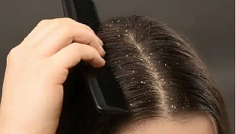 बालों में डैंड्रफ से हैं परेशान, इन घरेलू चीजों का करें इस्तेमाल