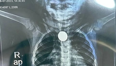 बच्ची की भोजन नली में फंसा सिक्का, महज 90 सेकेंड में हुई सर्जरी