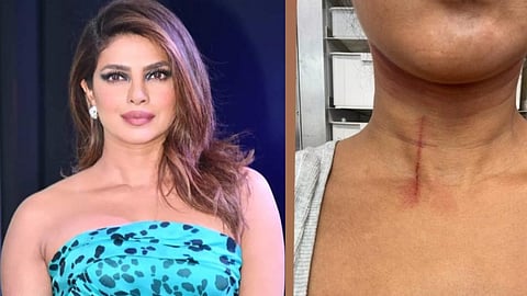 शूटिंग के दौरान प्रियंका चोपड़ा को लगी चोट