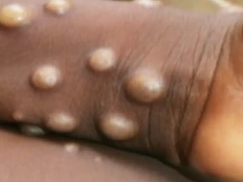 Monkey Pox : भारत में मंकीपॉक्स का पहला केस