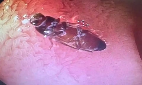 Shocking News: दिल्ली में मरीज के पेट से निकला जिंदा कॉकरोच, 3 दिनों तक पेट में…..