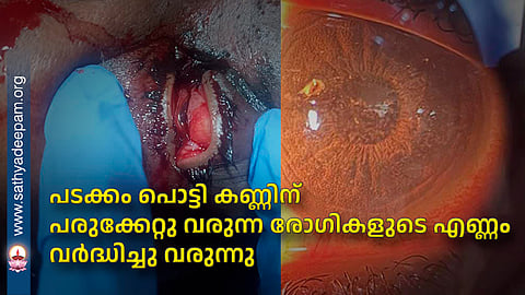 പടക്കം പൊട്ടി കണ്ണിന് പരുക്കേറ്റു വരുന്ന രോഗികളുടെ എണ്ണം വര്ദ്ധിച്ചു വരുന്നു