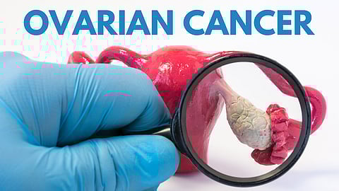 Routine screening key for early detection of ovarian cancer: Experts
