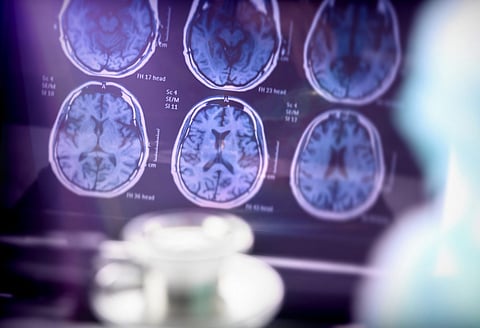 How brain scans can give distorted readings in some people