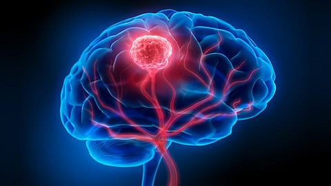 Drugs that treat HIV, AIDS trialled in people with brain tumour