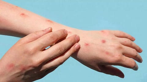 How India can Protect Itself from Mpox