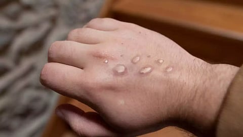 After Sweden, Thailand detects 1st ‘suspected case of new Mpox strain’