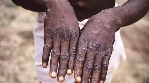 Is Mpox a new threat?